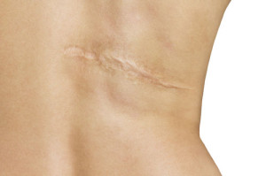 preventing scar, Burn scar back
