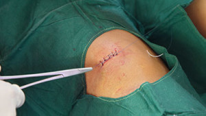 surgical scar