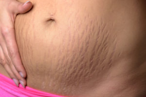 stretch marks