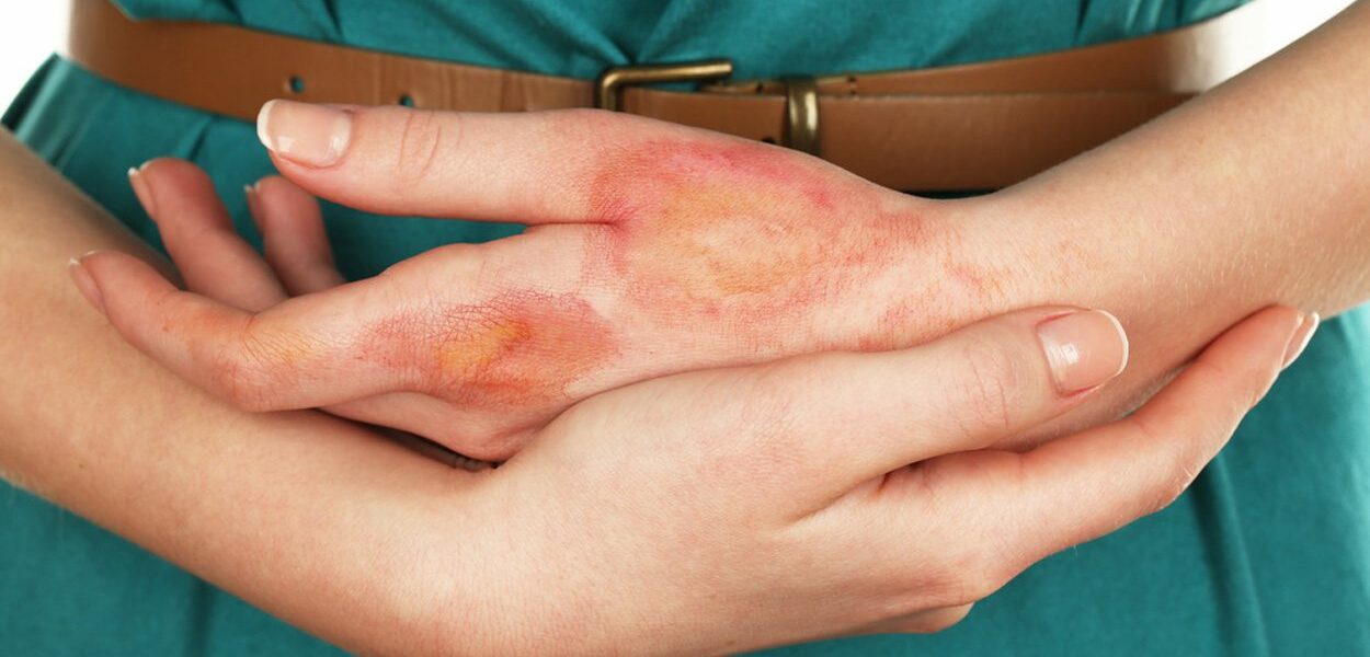 Preventing scars after a burn wound