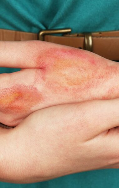 Preventing scars after a burn wound