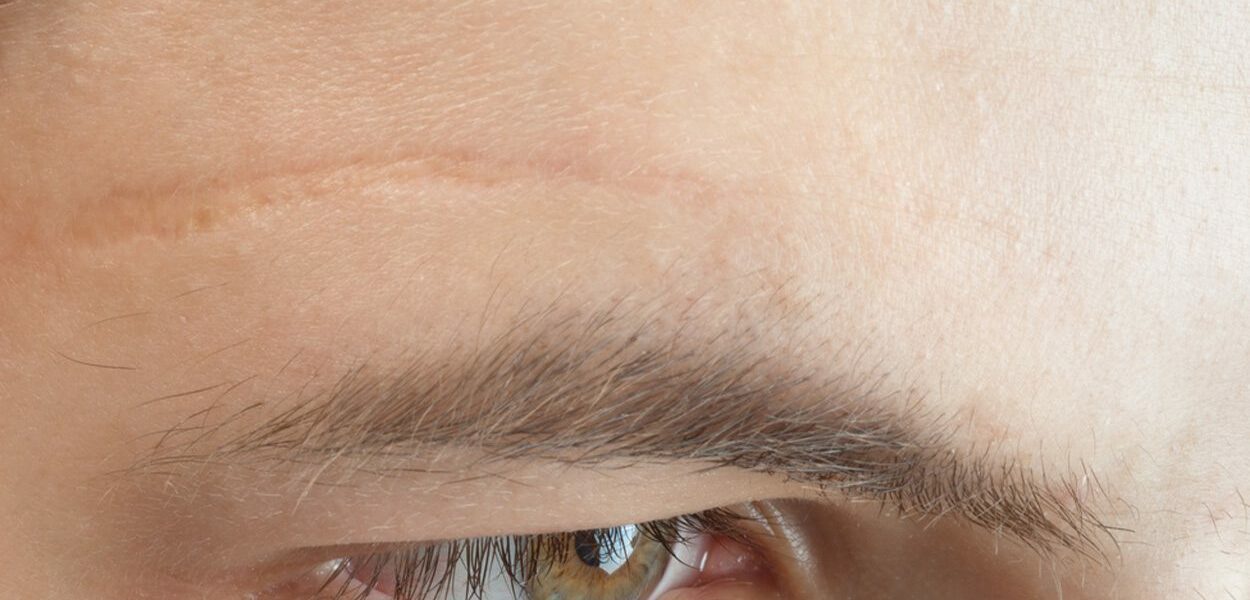 Can I remove facial scars with scar cream