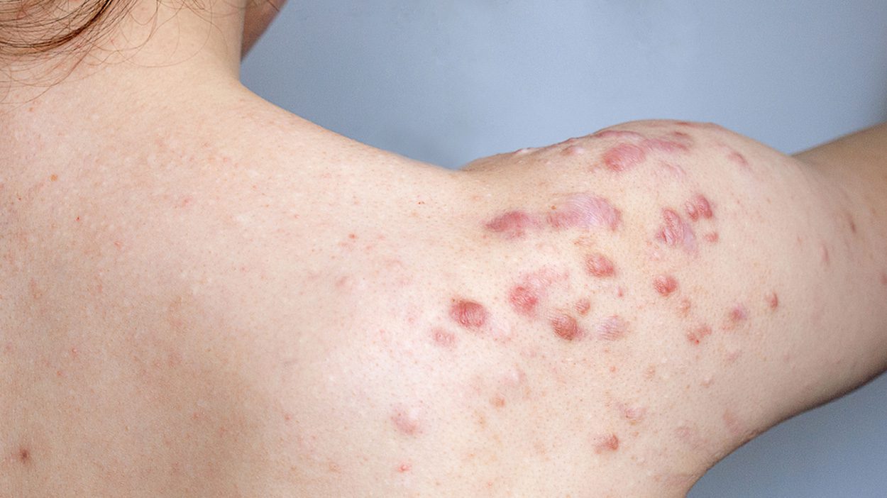 Acne Scar Treatment ALHYDRAN CO UK