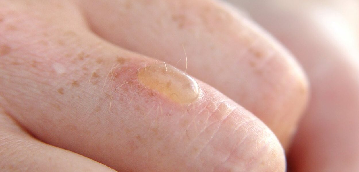 How do you treat a burn blister?