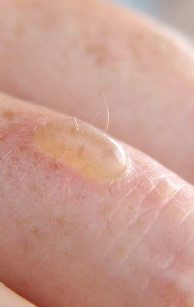 How do you treat a burn blister?