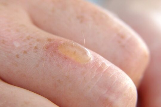 How do you treat a burn blister?