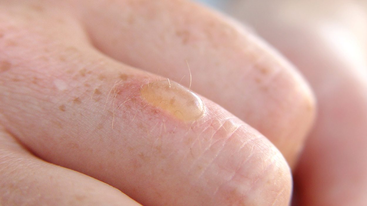 How do you treat a burn blister? ALHYDRAN CO UK