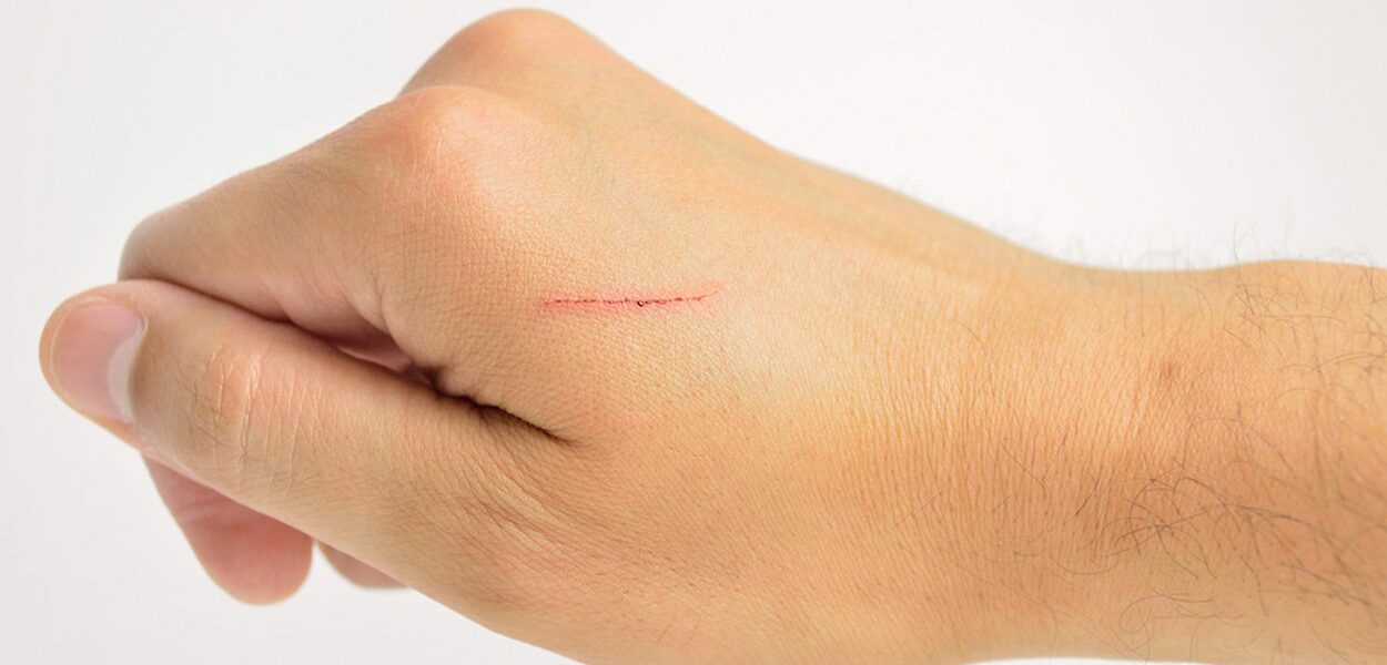 Remove small scars with scar cream