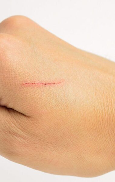 Remove small scars with scar cream