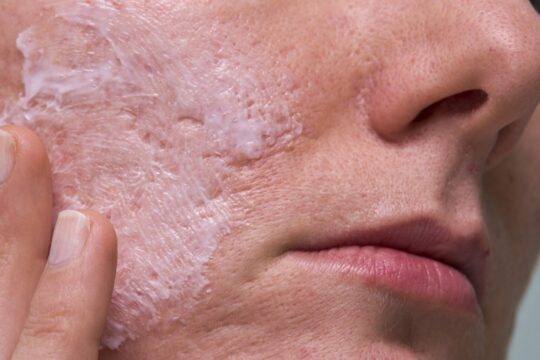 Acne scar treatment