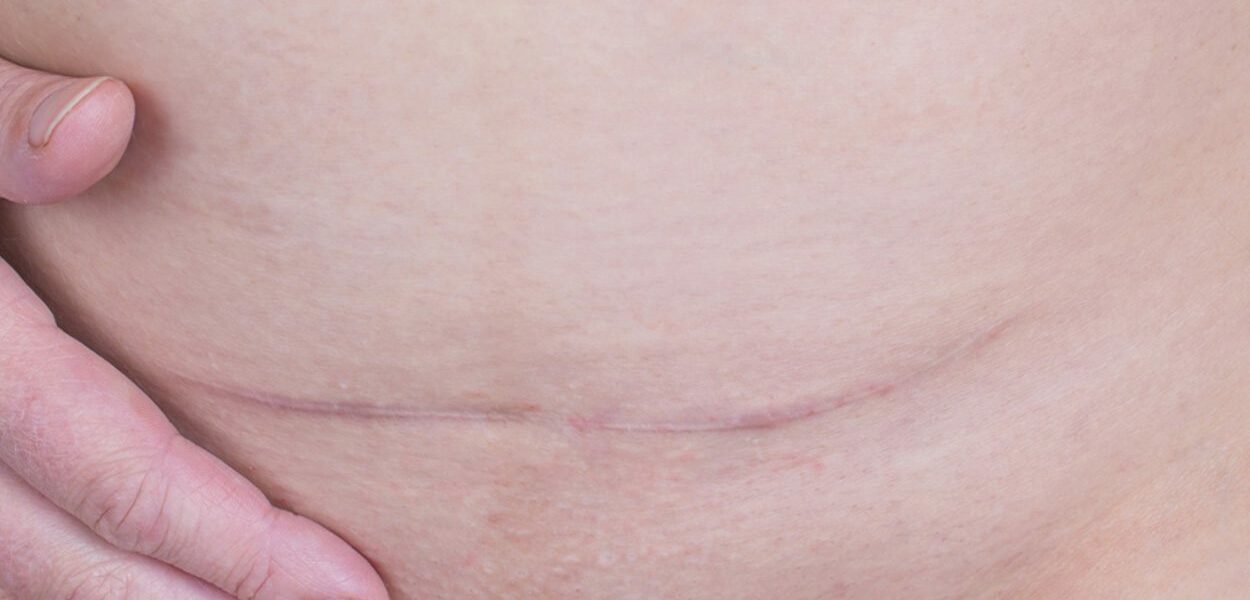 How to care for a caesarean scar