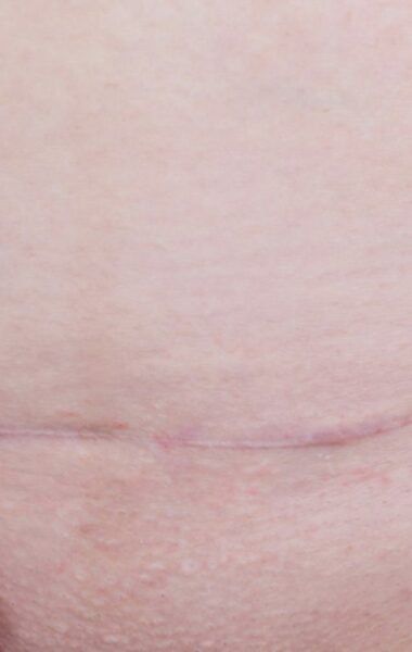 How to care for a caesarean scar