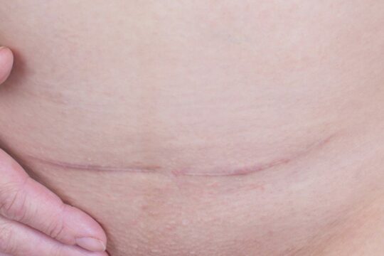 How to care for a caesarean scar
