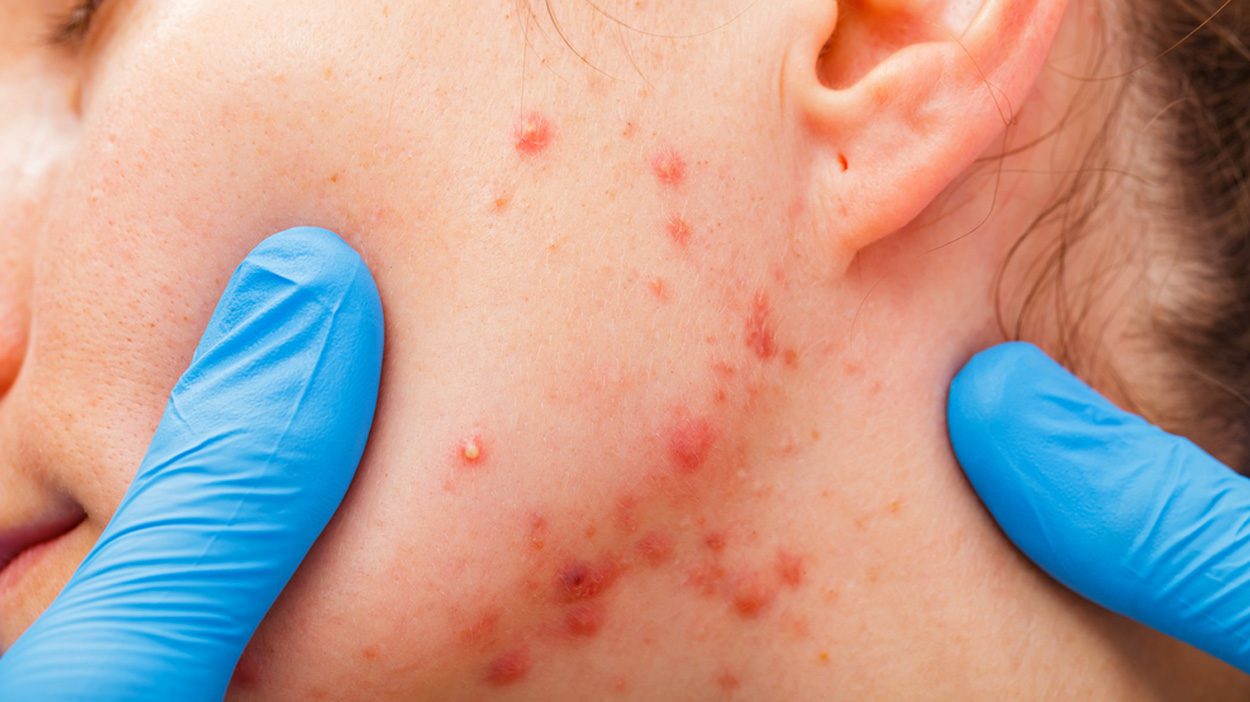 Tips for preventing acne scars