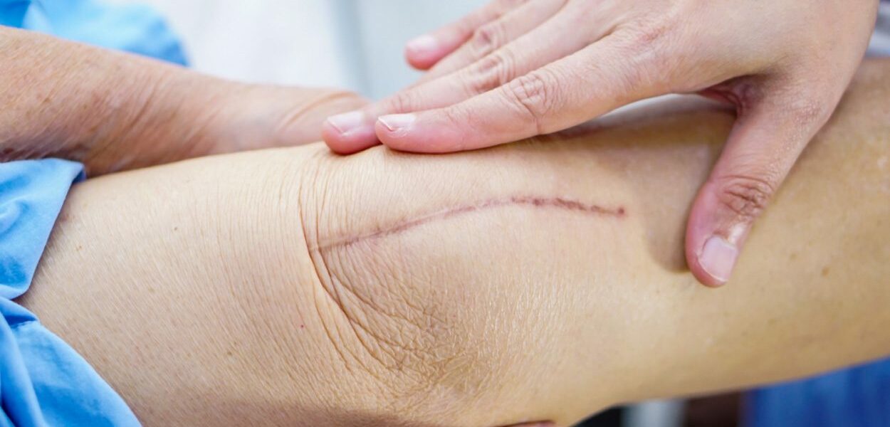 Healing a surgical scar