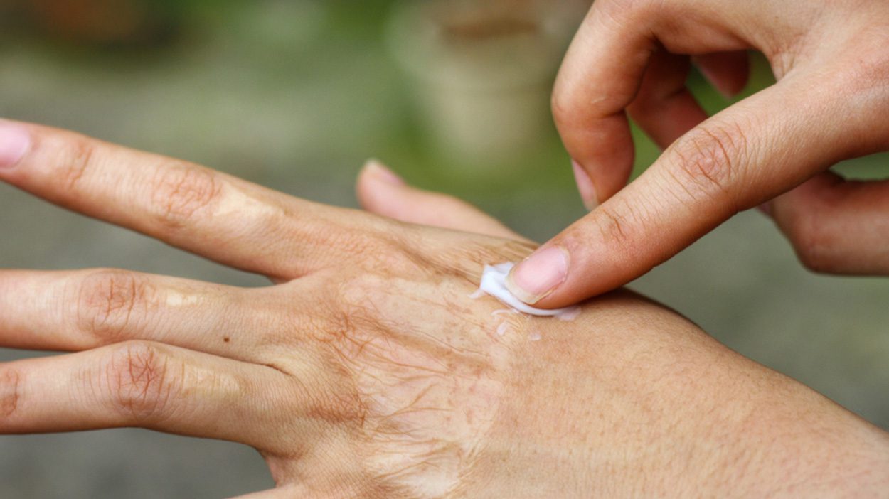 Vitamin E for scars, does it work? Does ALHYDRAN contains vitamin E