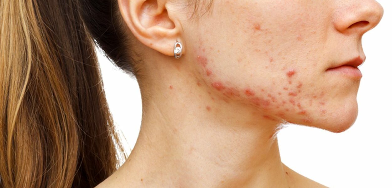 Remove acne scars: practical tips for home treatment