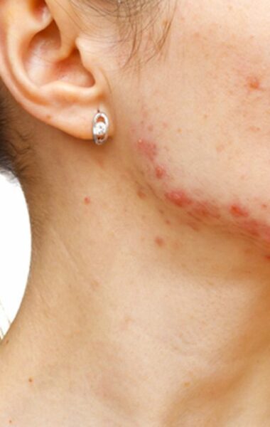 Remove acne scars: practical tips for home treatment