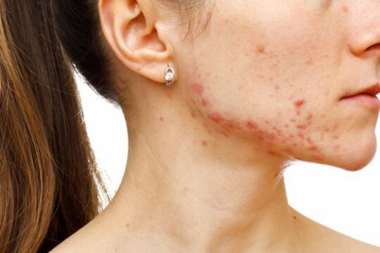 Remove acne scars: practical tips for home treatment