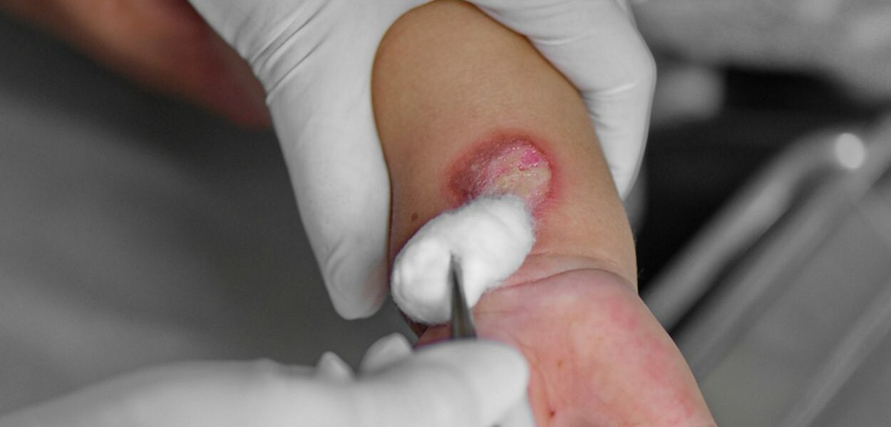 Second degree burns and preventing scars