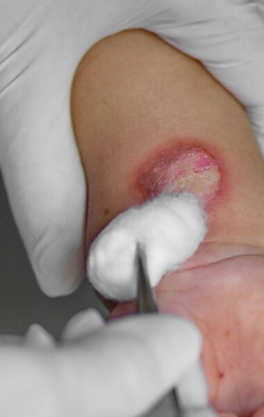 Second degree burns and preventing scars