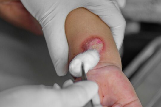 Second degree burns and preventing scars
