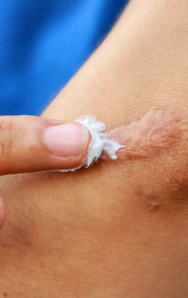 ALHYDRAN anti-scar cream