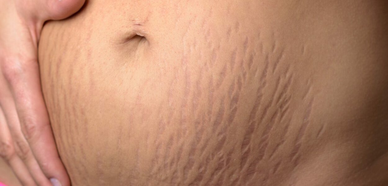 Reducing pregnancy stretch marks