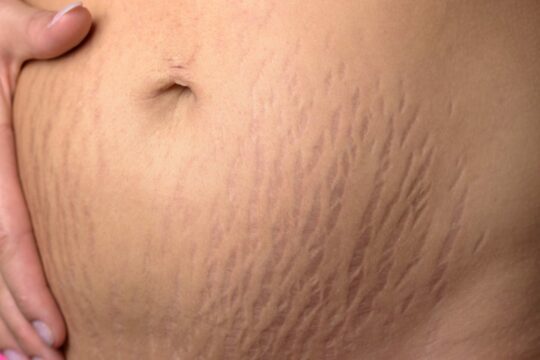 Reducing pregnancy stretch marks