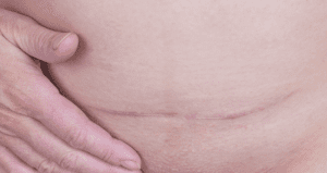 c section scar