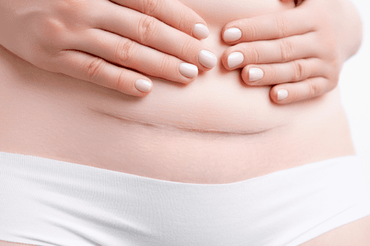 c section scar cream