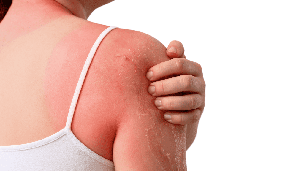 Sunburn itch