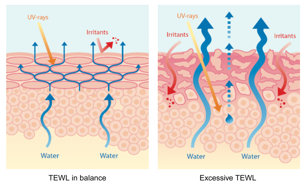 Healthy and damaged skin barrier