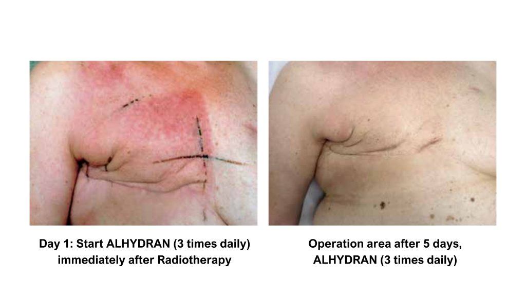 Before and after breast radiation therapy: visible reduction in redness and skin irritation after 5 days of using ALHYDRAN cream three times daily.