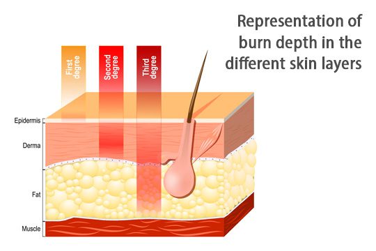 Burn dept in skin layers