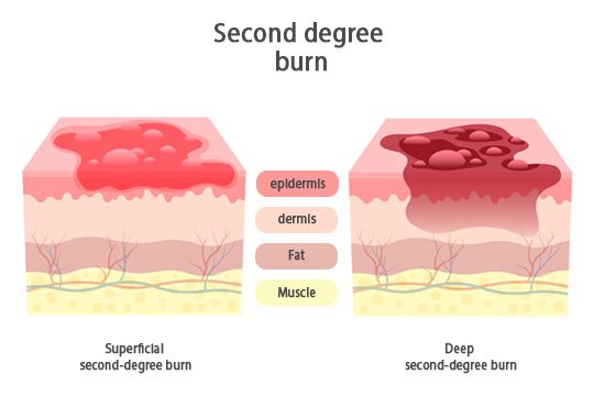 Second degree burn - superficial and deep burn wound