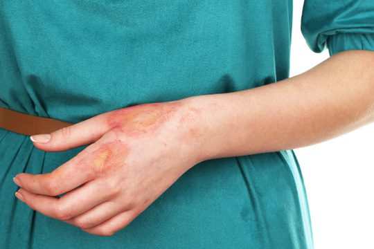 1st degree burn wound photo