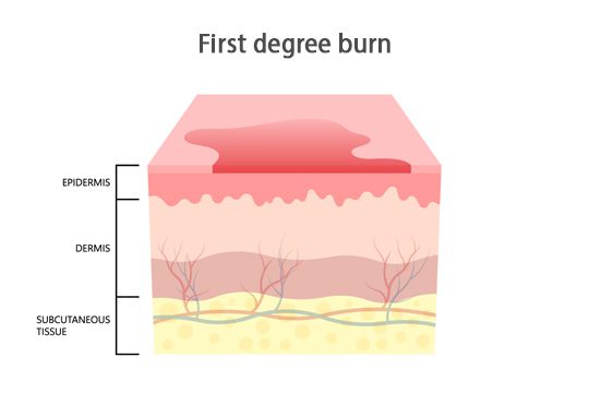 1st degree burn