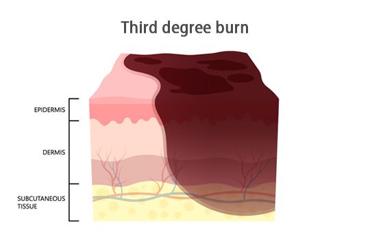 3rd degree burn