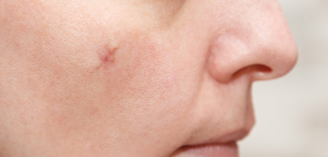 How to treat small scars on your face 1250×702