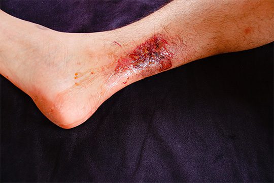 3rd degree burn appearance