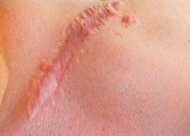 hypertrophic scar on skin, raised red scar within wound edges
