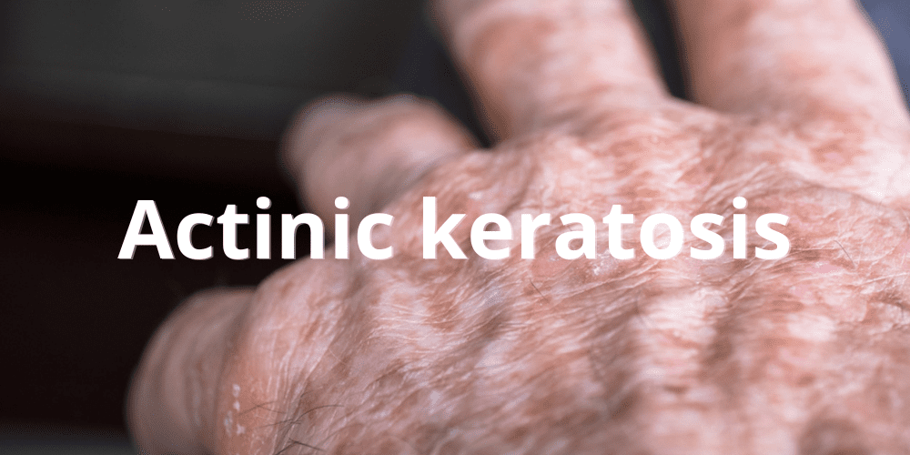 Actinic keratosis