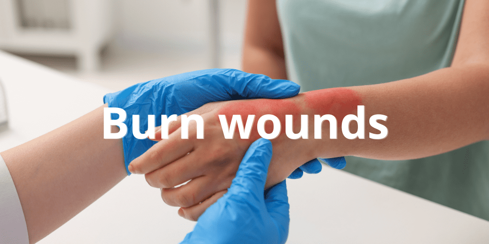 Burn wounds