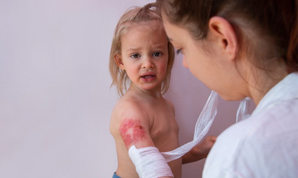 Parent bandaging a child's arm after a scald burn, showing red and healing skin