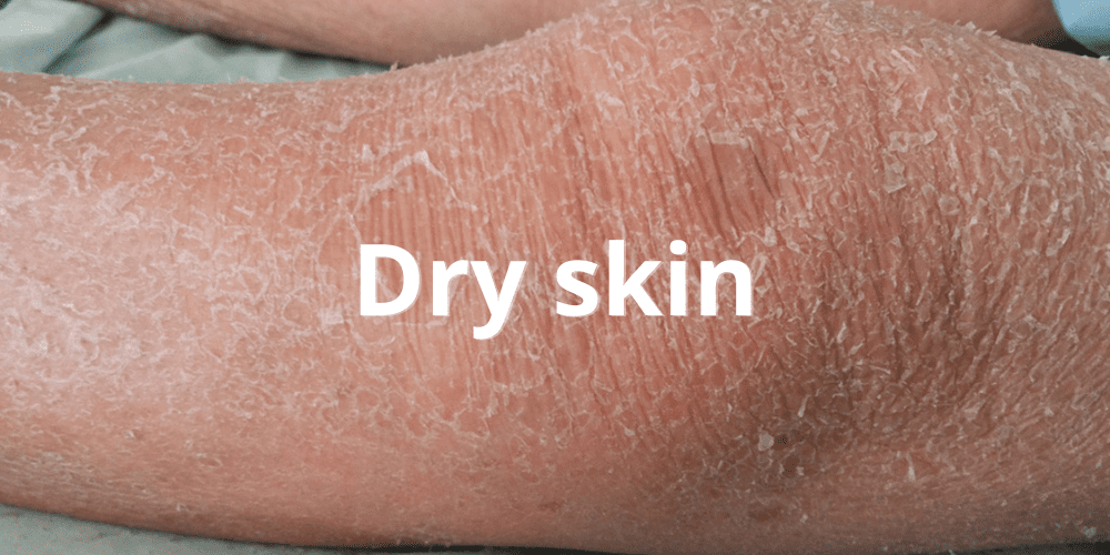 Dry Skin