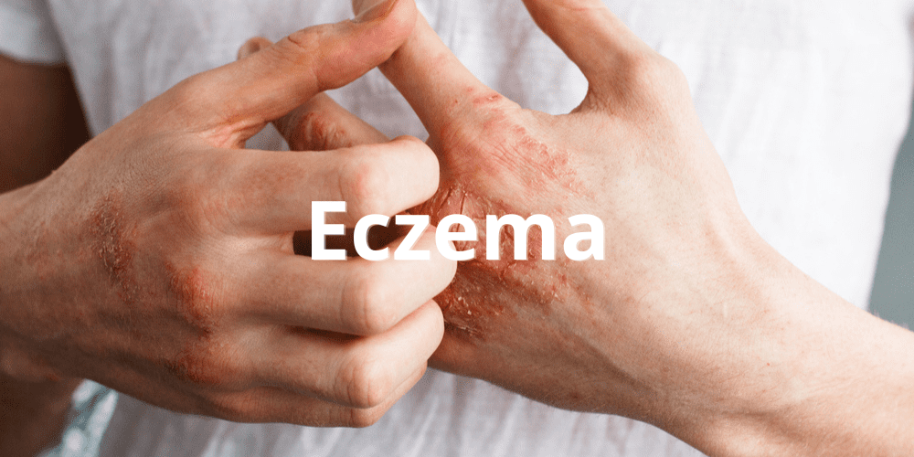 Eczema