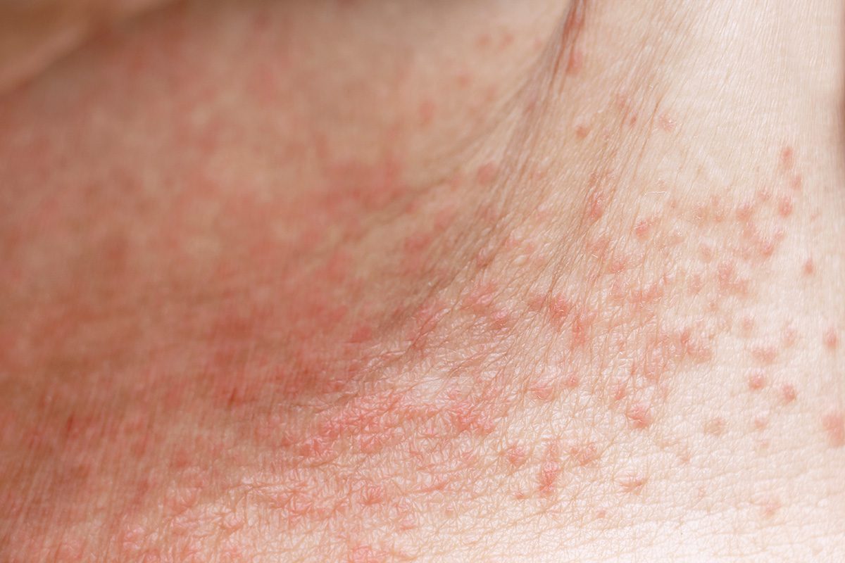 Heat rash symptoms