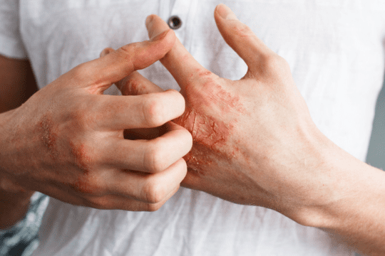 Anti Itch Cream for eczema