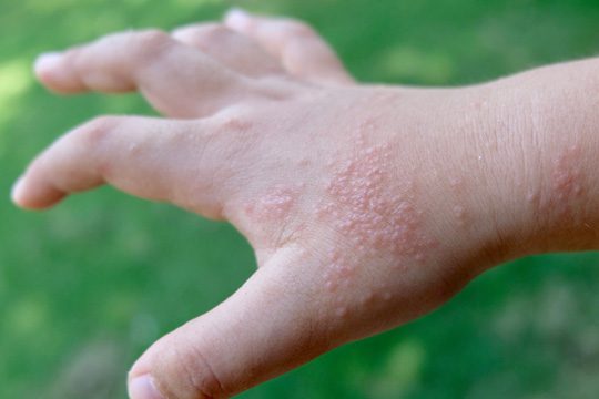 Dyshidrotic eczema on the hand with small itchy blisters and irritated skin.